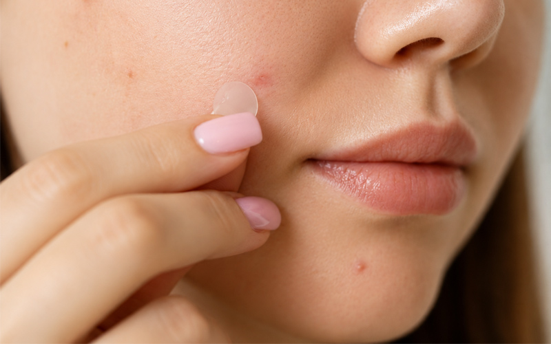 Acne and pimple treatment in Nellore at Sri Skin and Hair Clinic